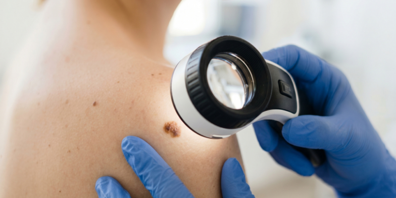How to Spot Skin Cancer Early: Warning Signs You Shouldn't Ignore